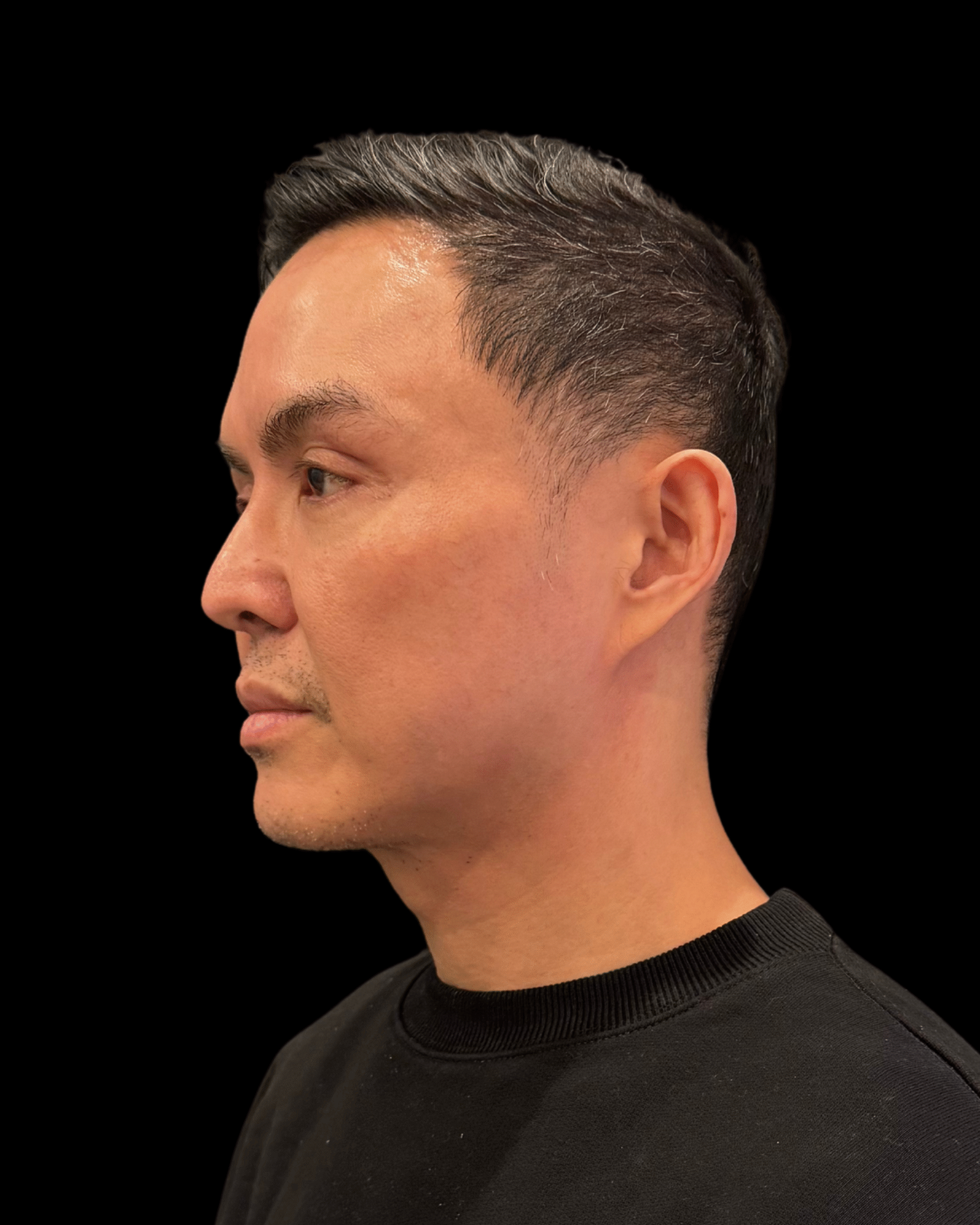 After Image: Ultherapy PRIME - left-front-oblique