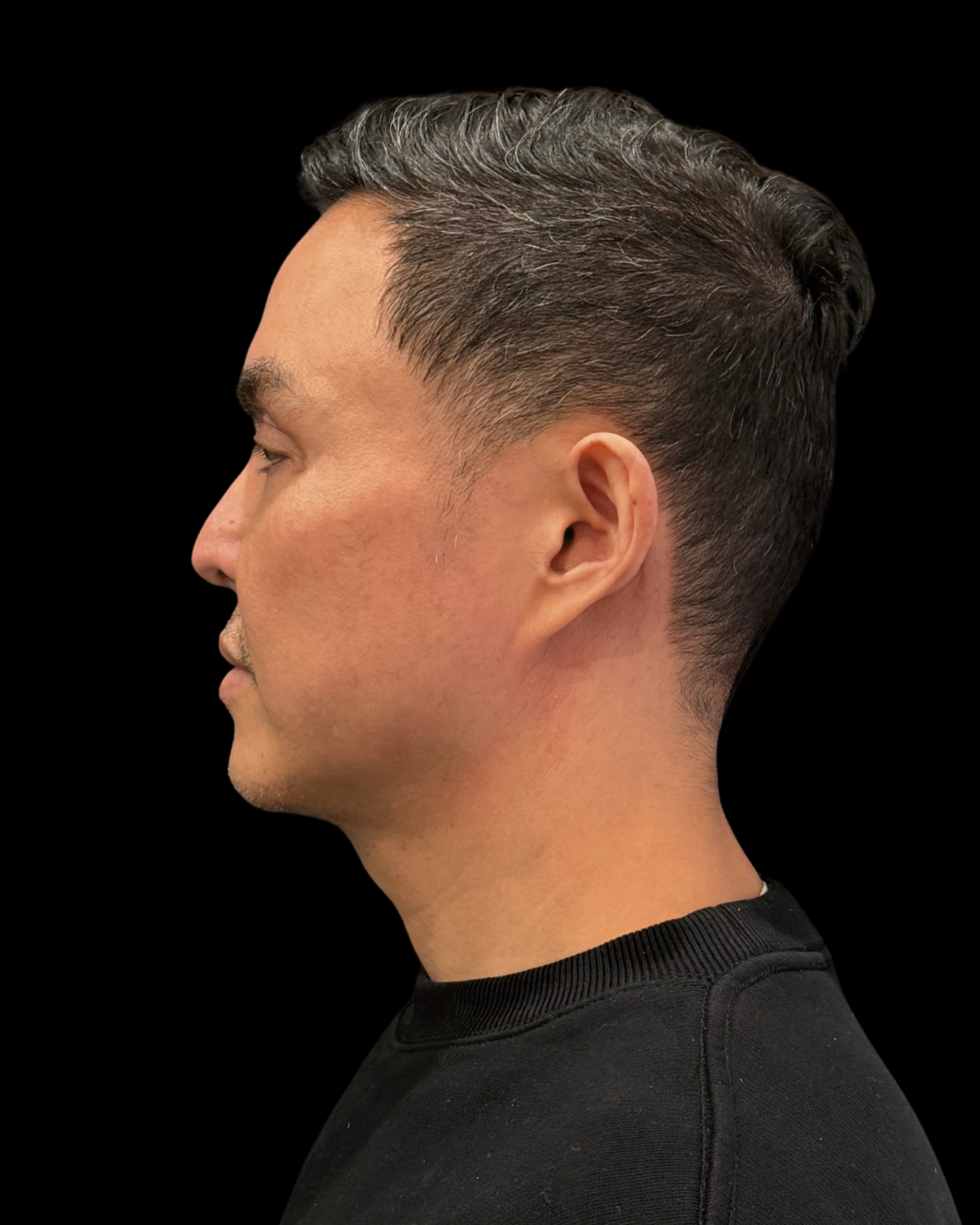 After Image: Ultherapy PRIME - left-side