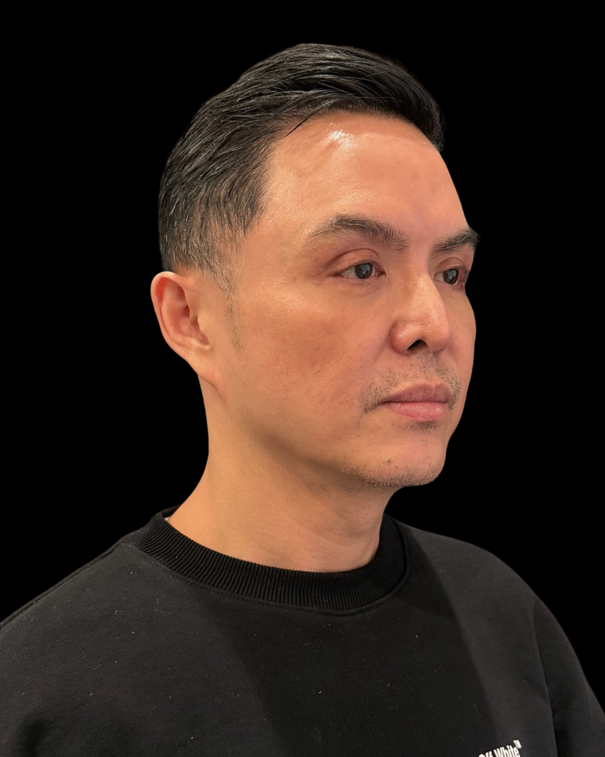 After Image: Ultherapy PRIME - right-front-oblique