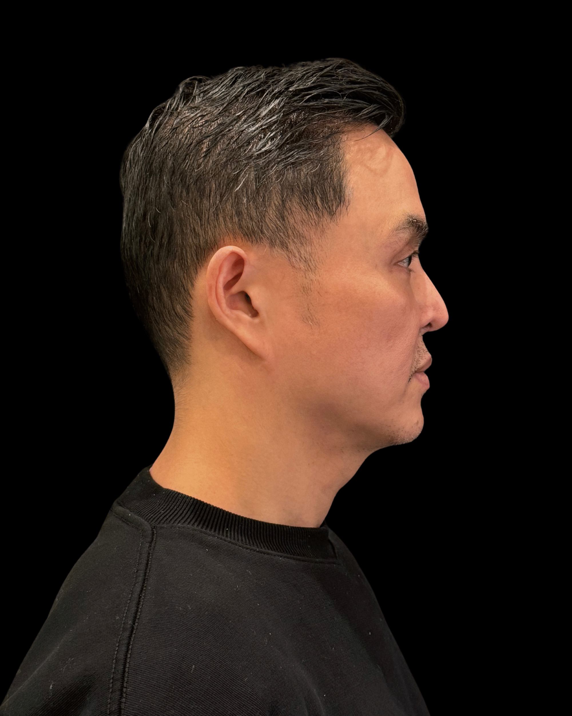 After Image: Ultherapy PRIME - right-side