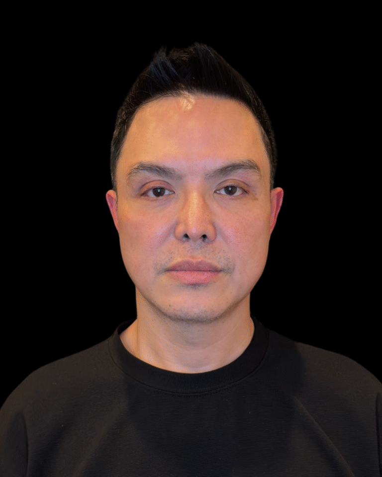 Before Image: Ultherapy PRIME - front