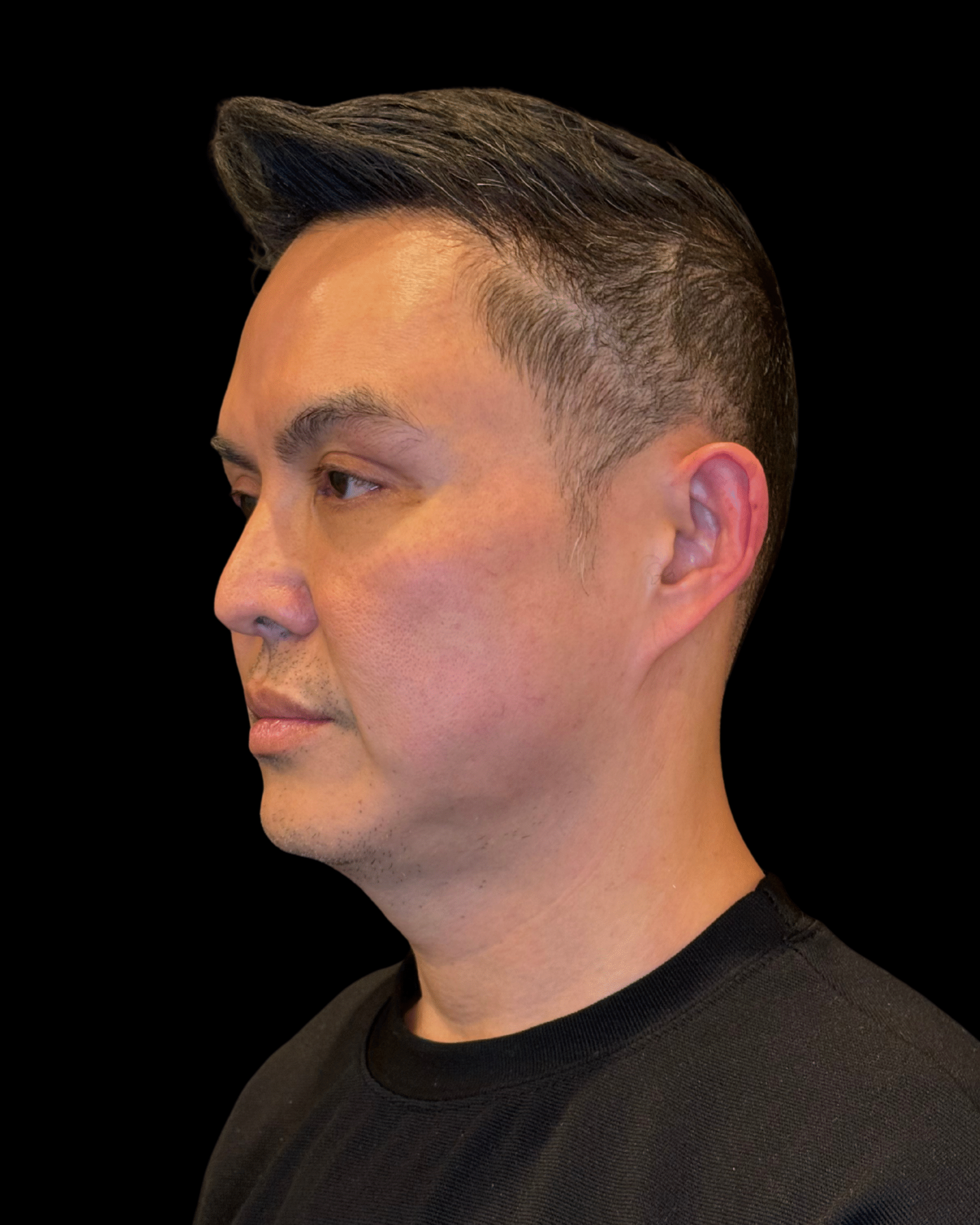 Before Image: Ultherapy PRIME - left-front-oblique