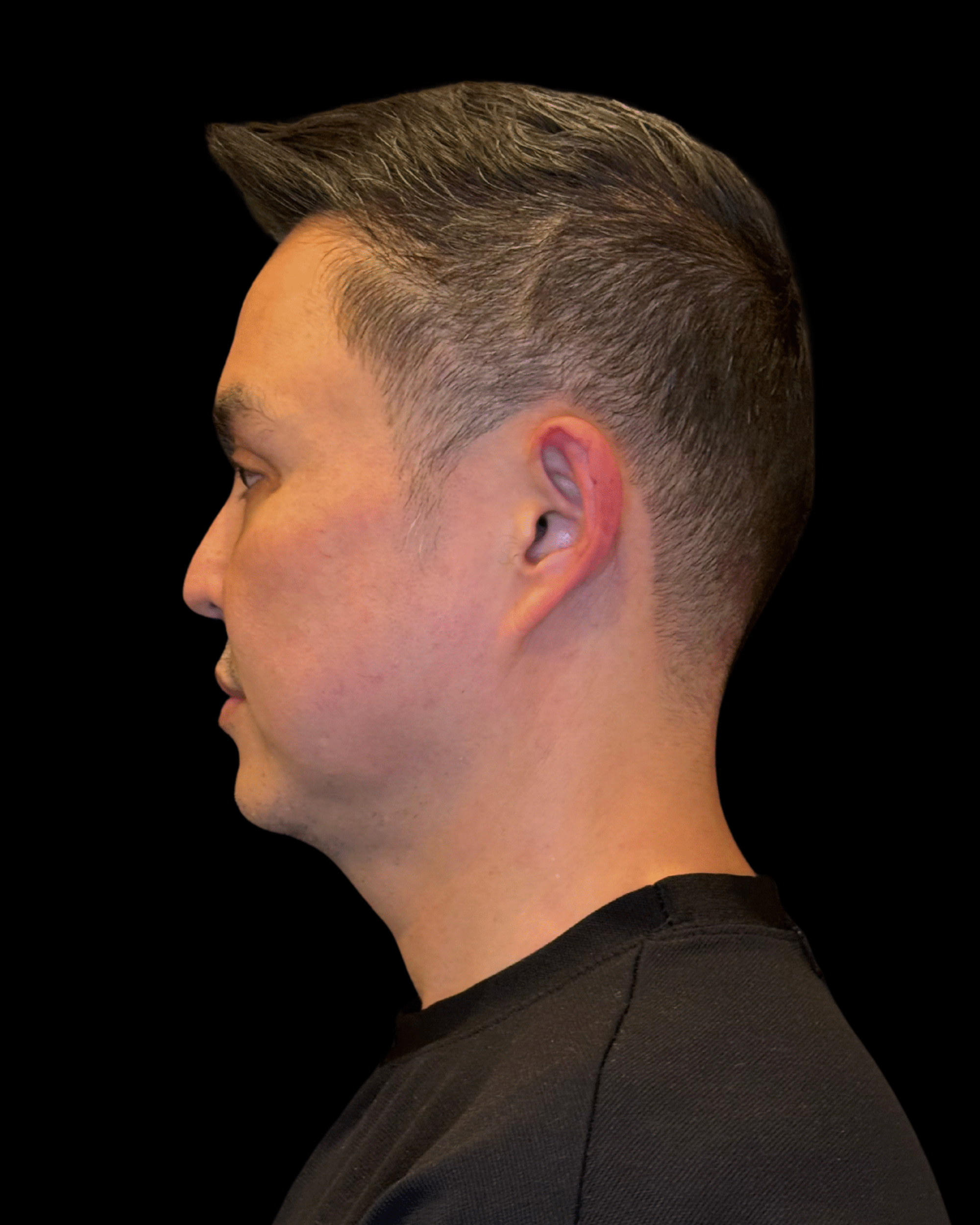 Before Image: Ultherapy PRIME - left-side