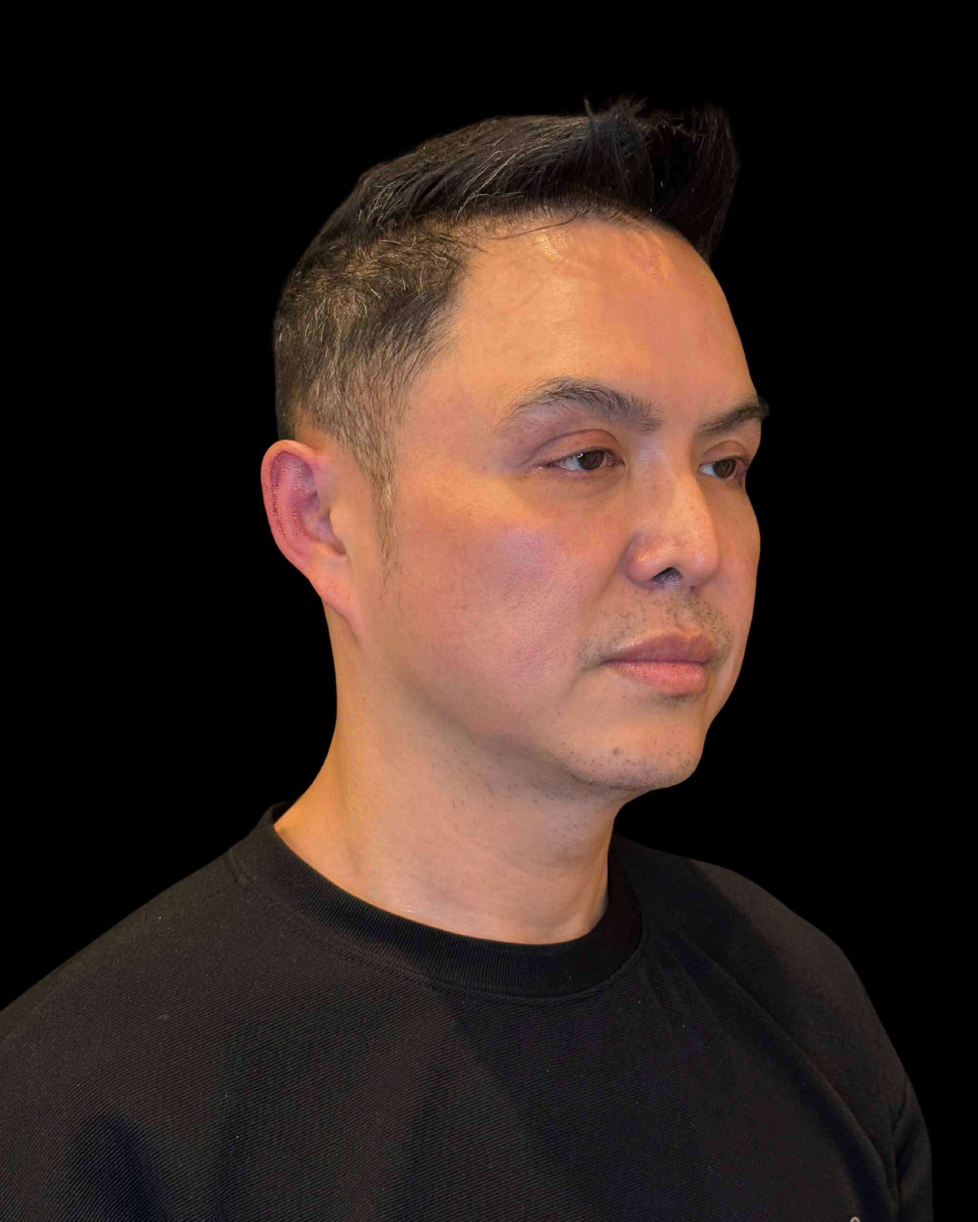 Before Image: Ultherapy PRIME - right-front-oblique