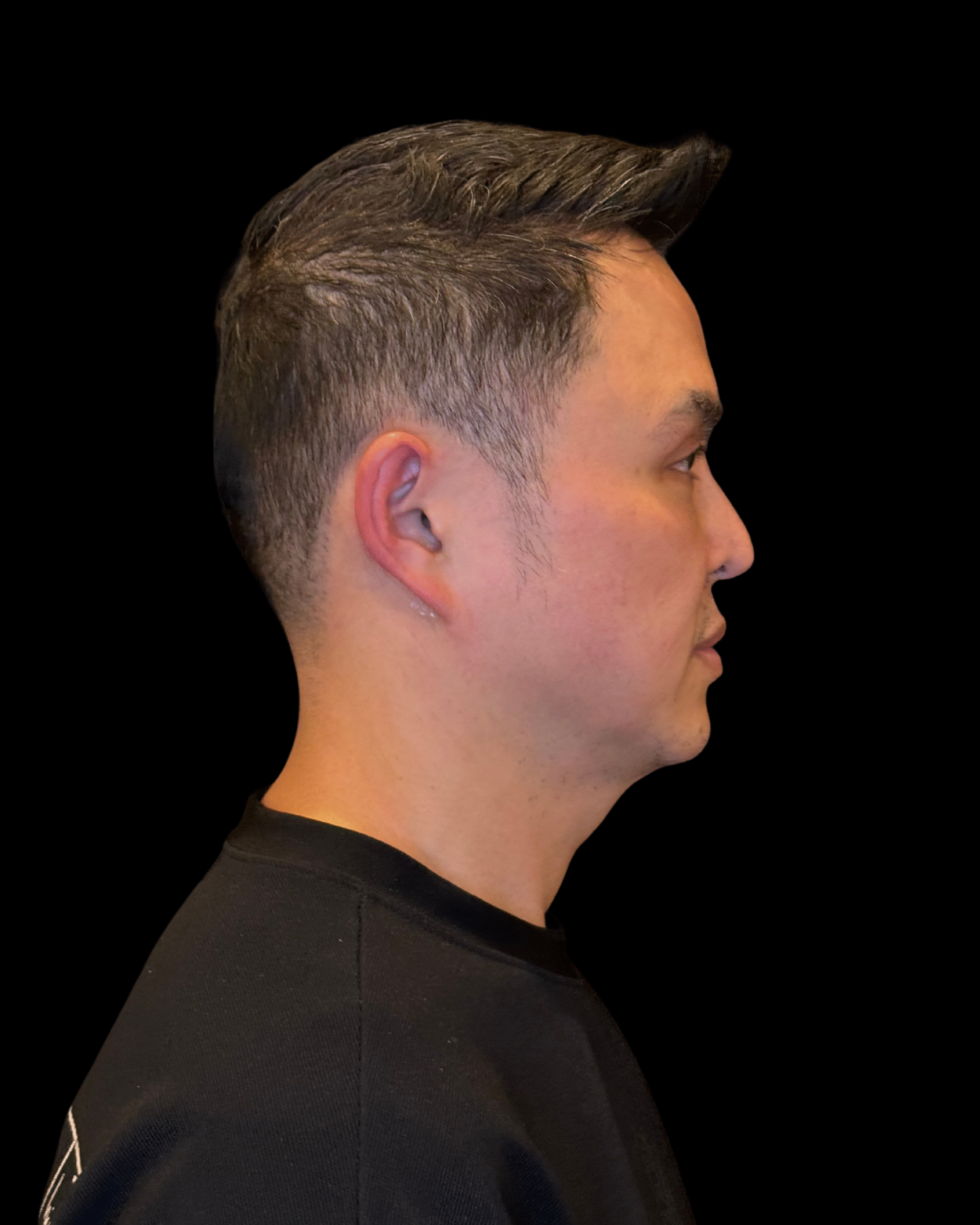 Before Image: Ultherapy PRIME - right-side