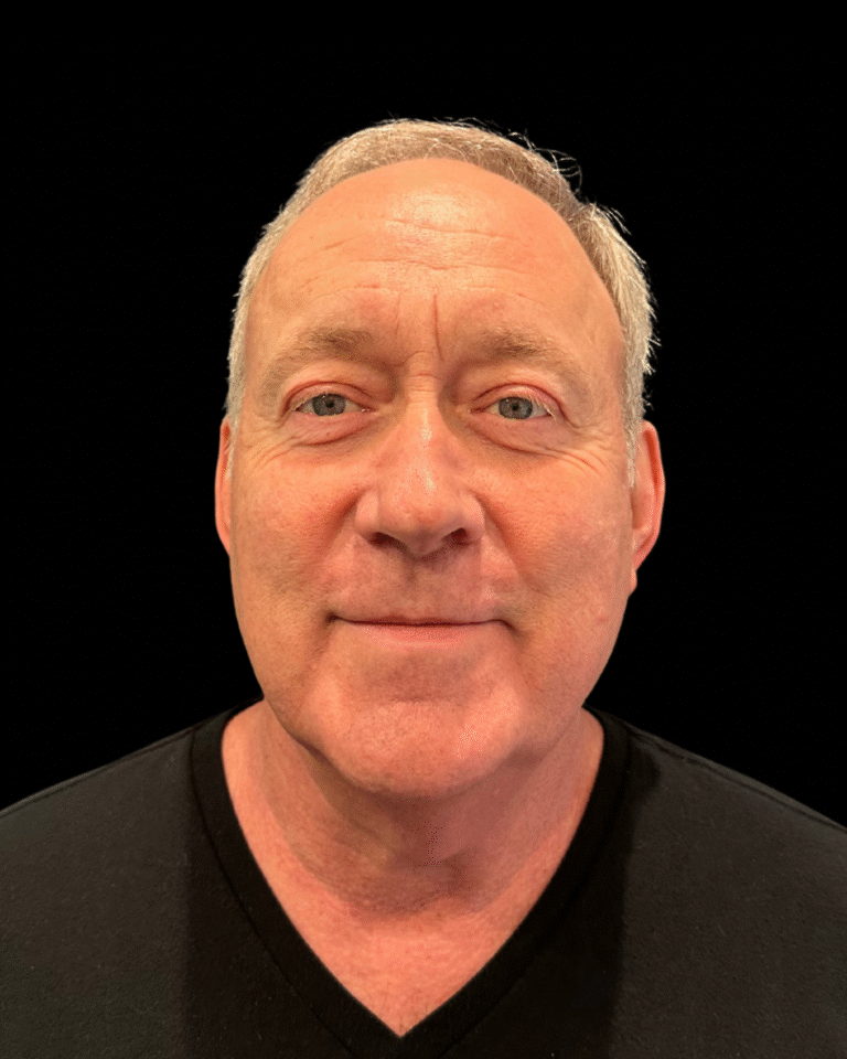 After Image: Ultherapy PRIME - front