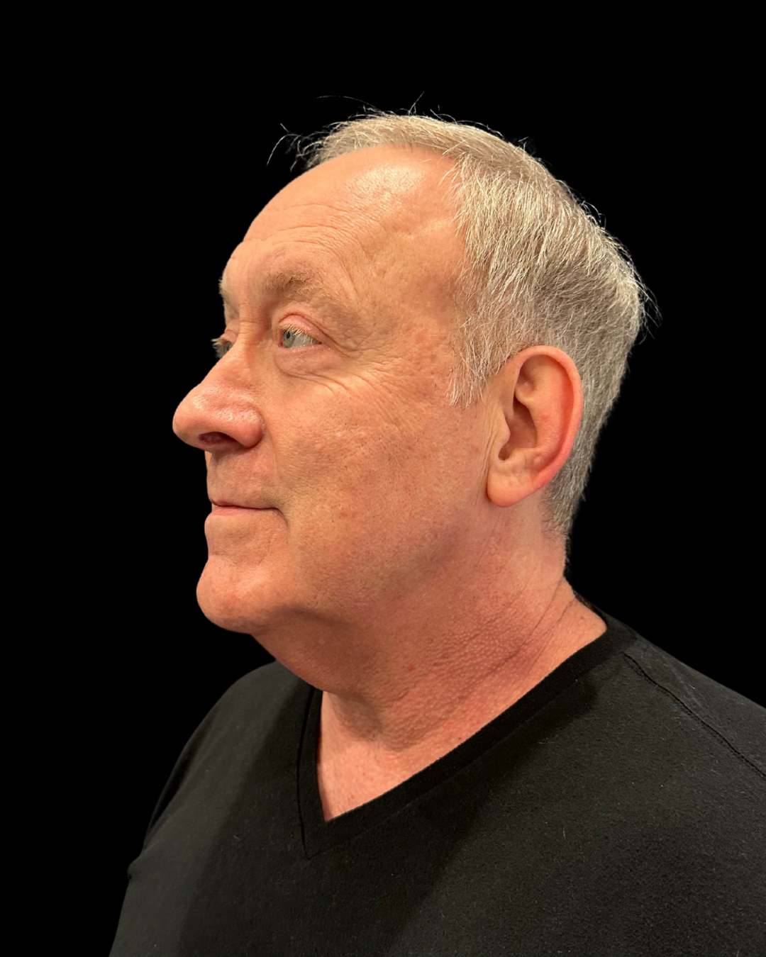 After Image: Ultherapy PRIME - left-front-oblique