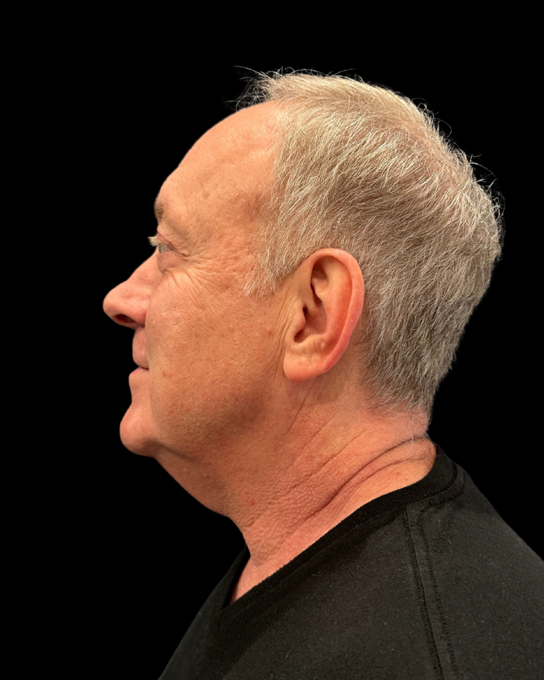 After Image: Ultherapy PRIME - left-side