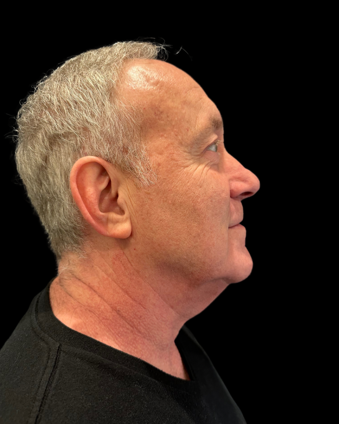 After Image: Ultherapy PRIME - right-side