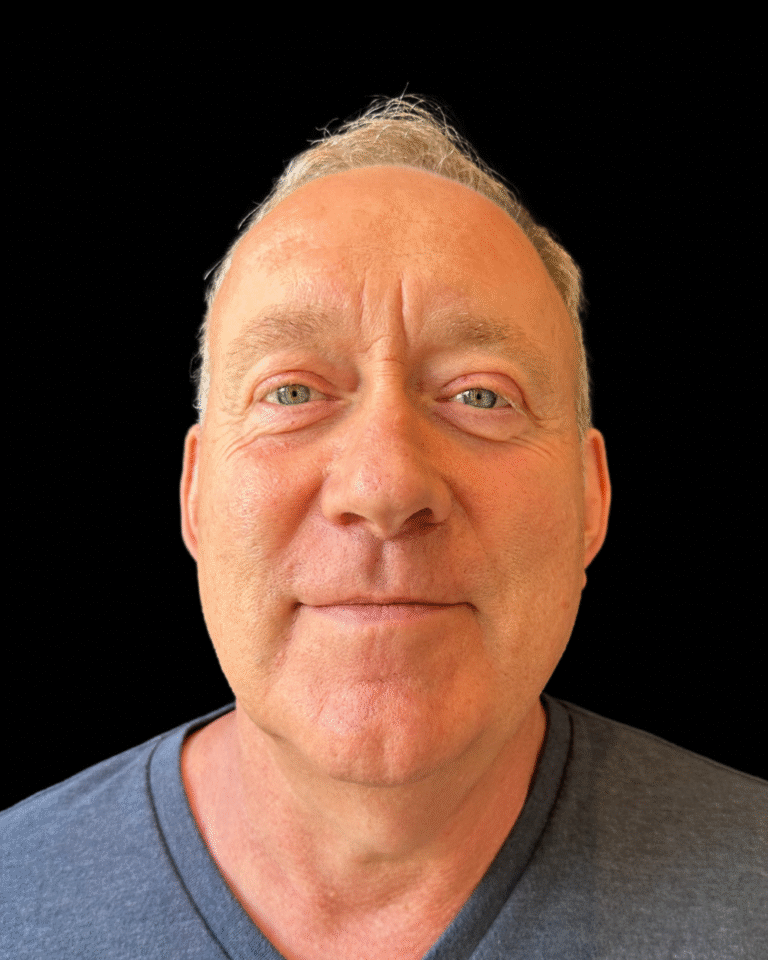 Before Image: Ultherapy PRIME - front