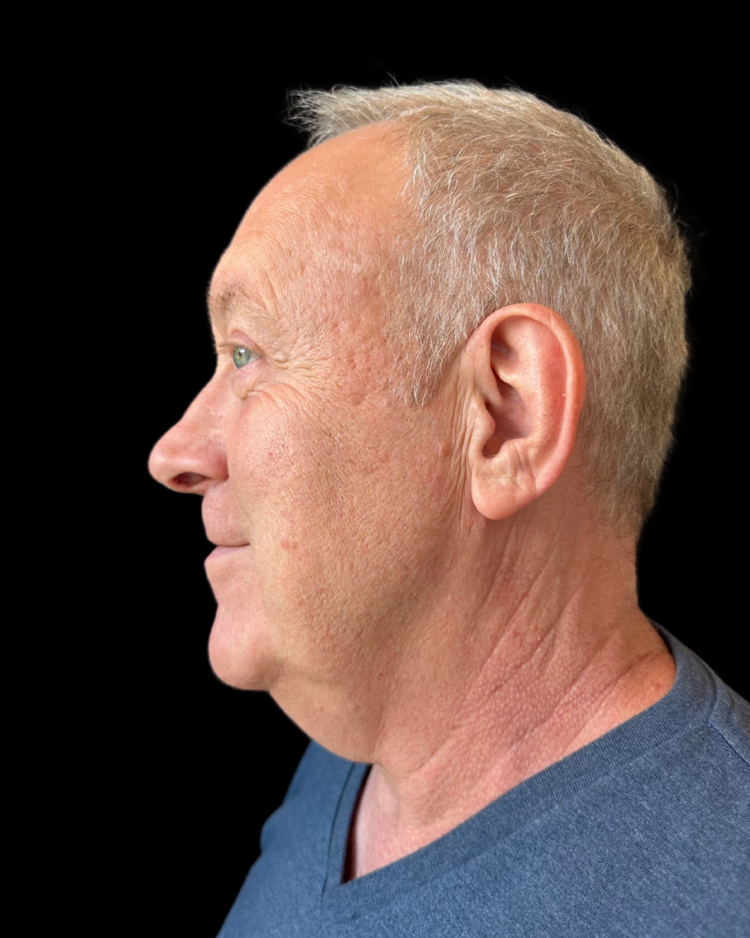 Before Image: Ultherapy PRIME - left-side