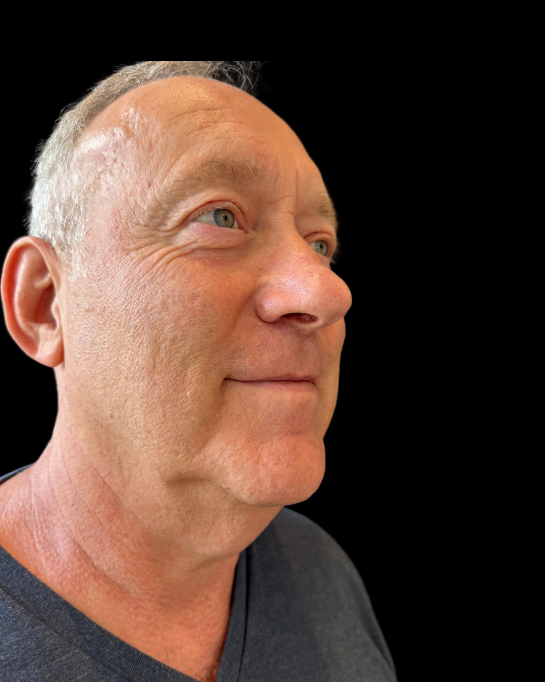 Before Image: Ultherapy PRIME - right-front-oblique