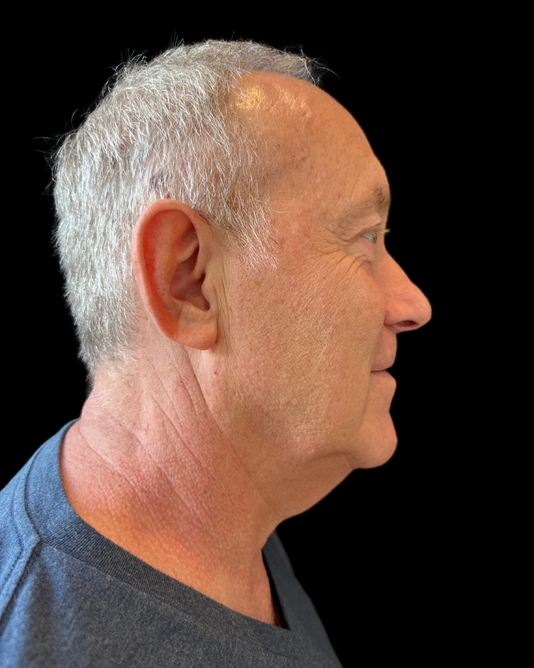 Before Image: Ultherapy PRIME - right-side