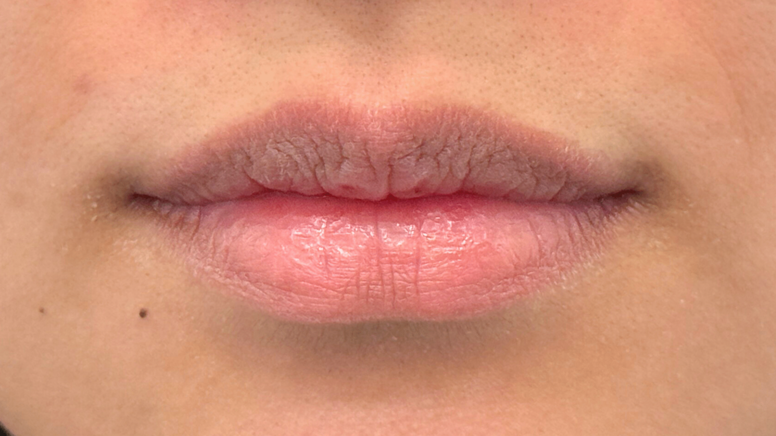 Before Image: Restylane Kysse Lip Filler - front