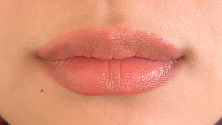 After Image: Restylane Kysse Lip Filler - front