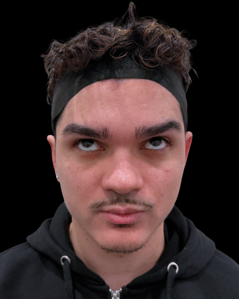 After Image: Xeomin - front