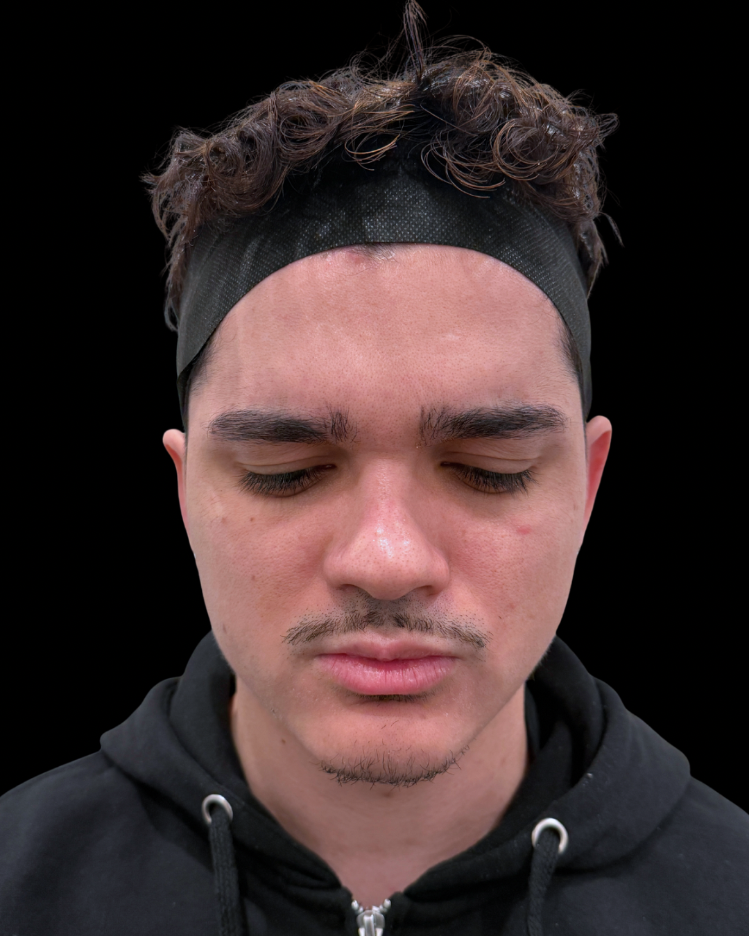 After Image: Xeomin - front
