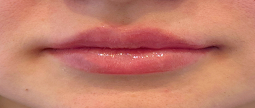 After Image: Restylane Kysse Lip Filler - front