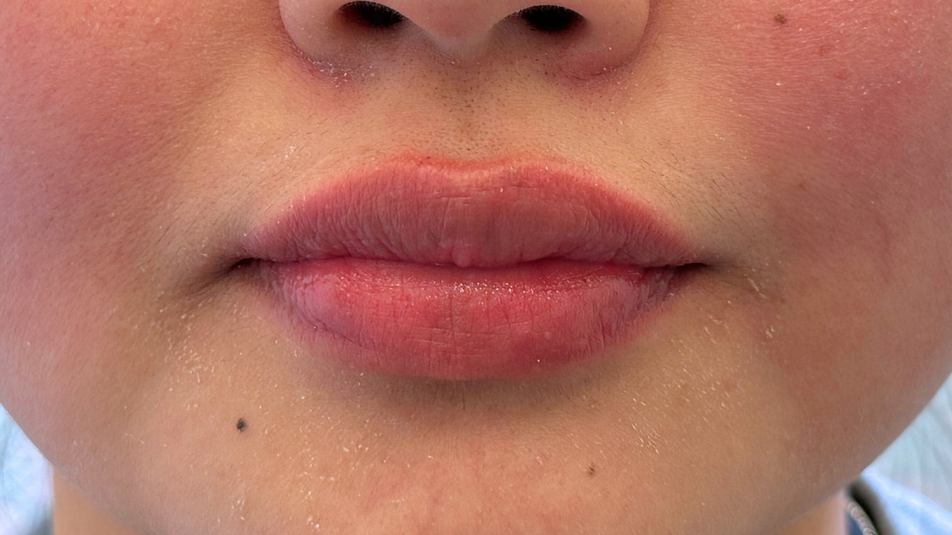 After Image: Restylane Kysse Lip Filler - front