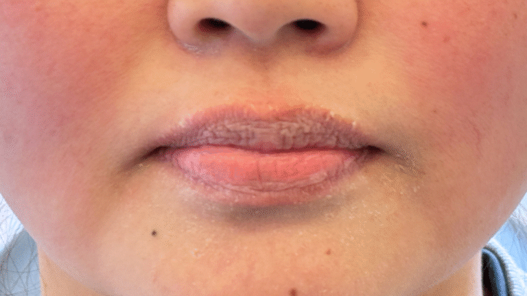 Before Image: Restylane Kysse Lip Filler - front
