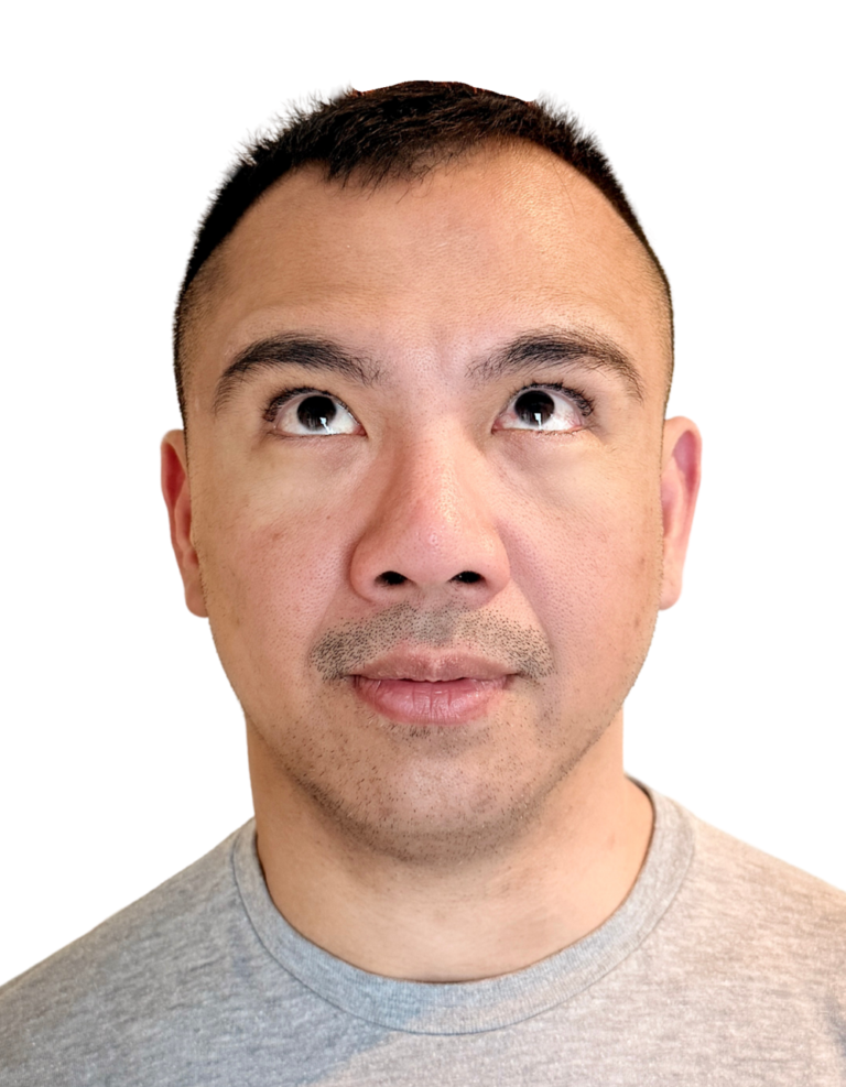 After Image: BOTOX - front