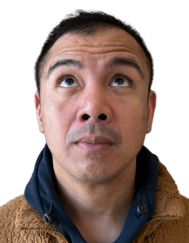 Before Image: BOTOX - front