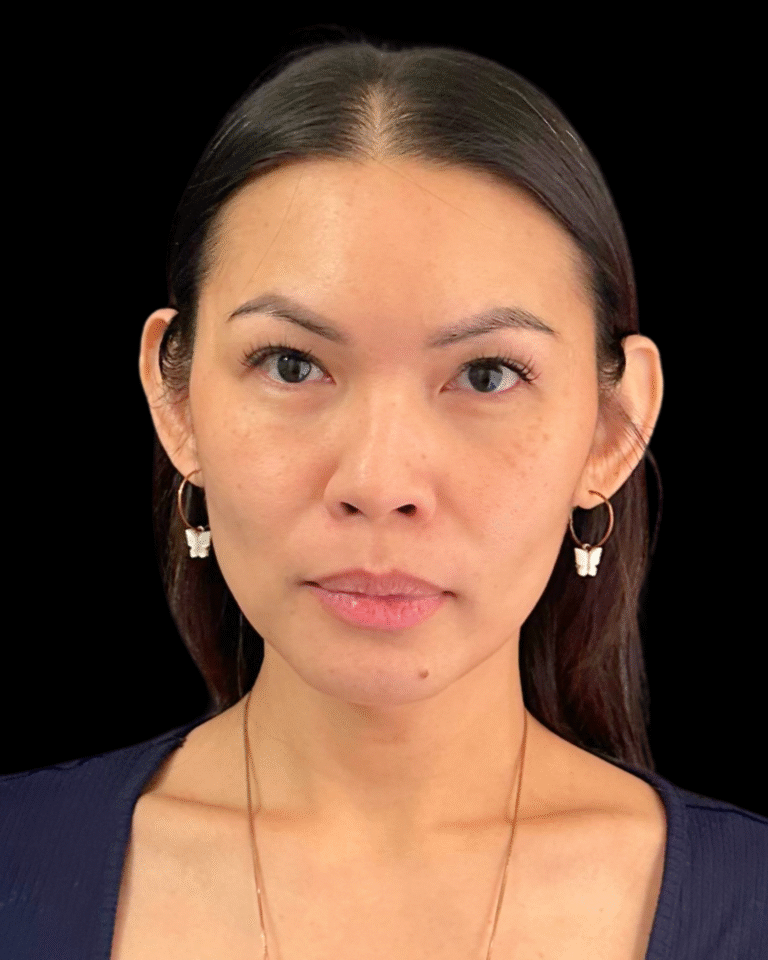 After Image: Ultherapy PRIME - front