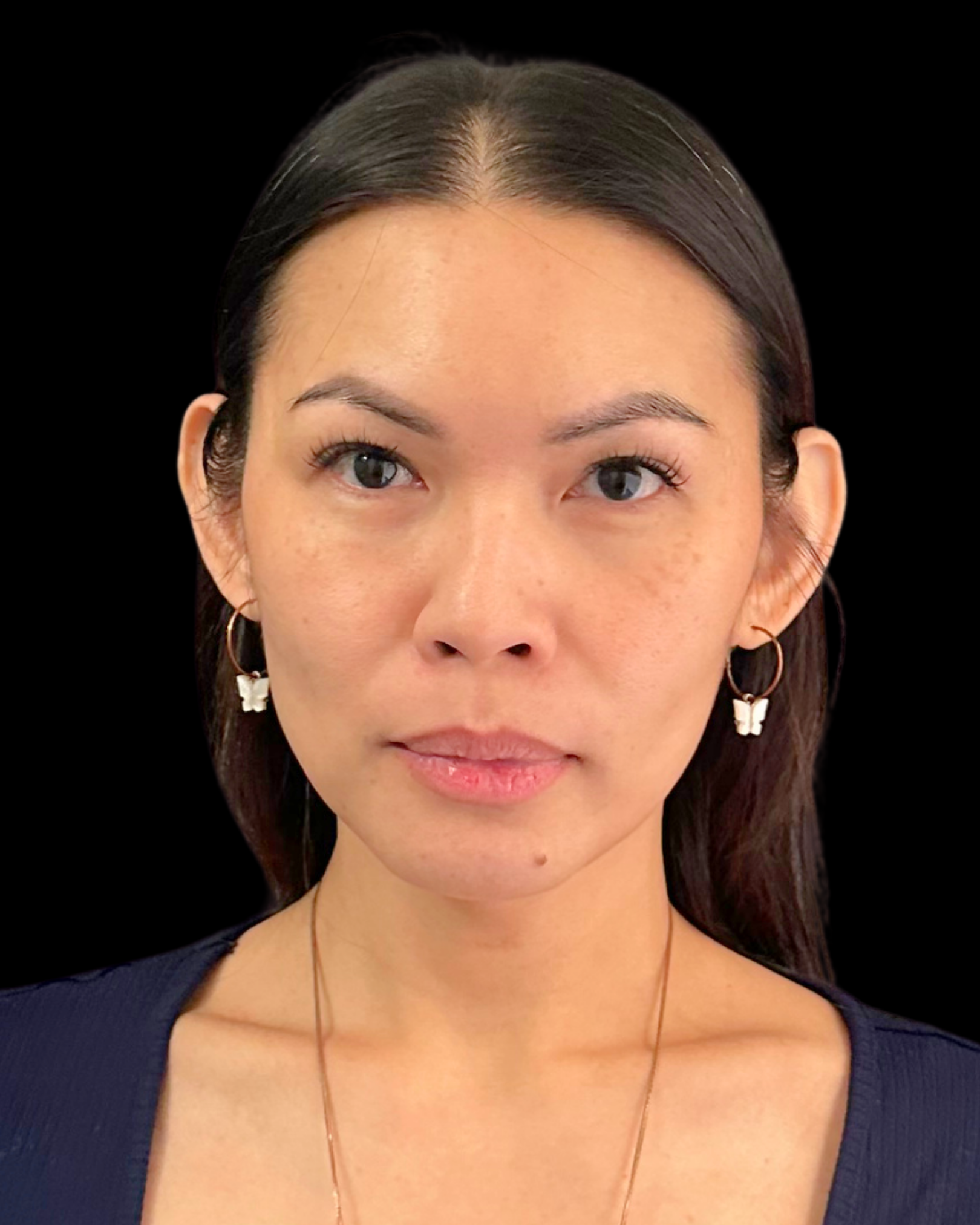 After Image: Ultherapy PRIME - front