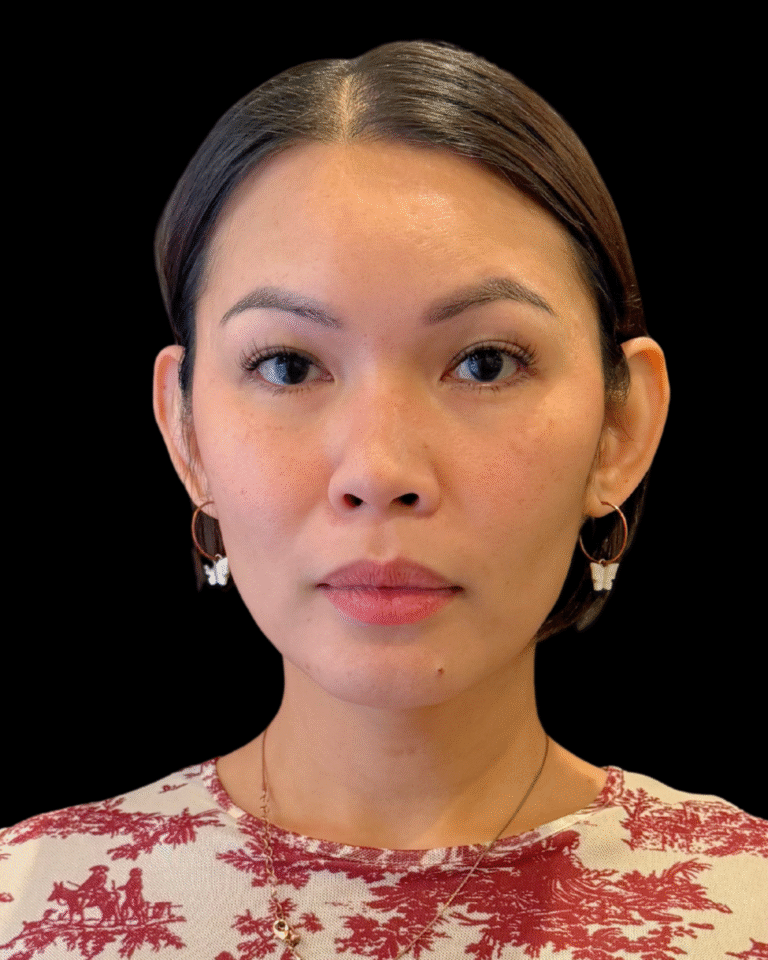 Before Image: Ultherapy PRIME - front