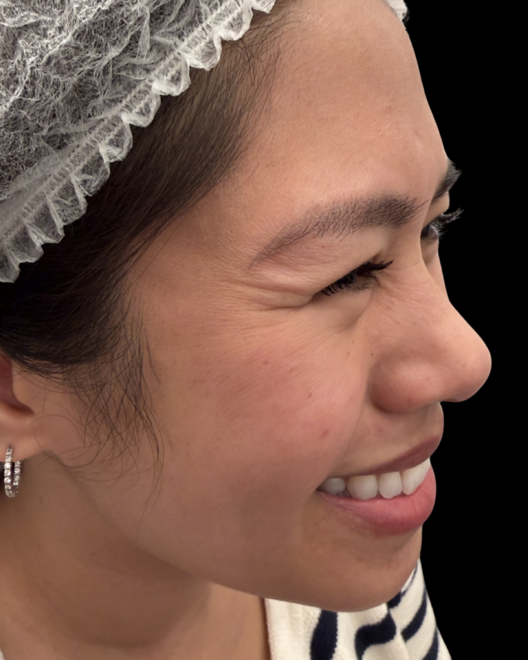 Before Image: Xeomin - right-front-oblique