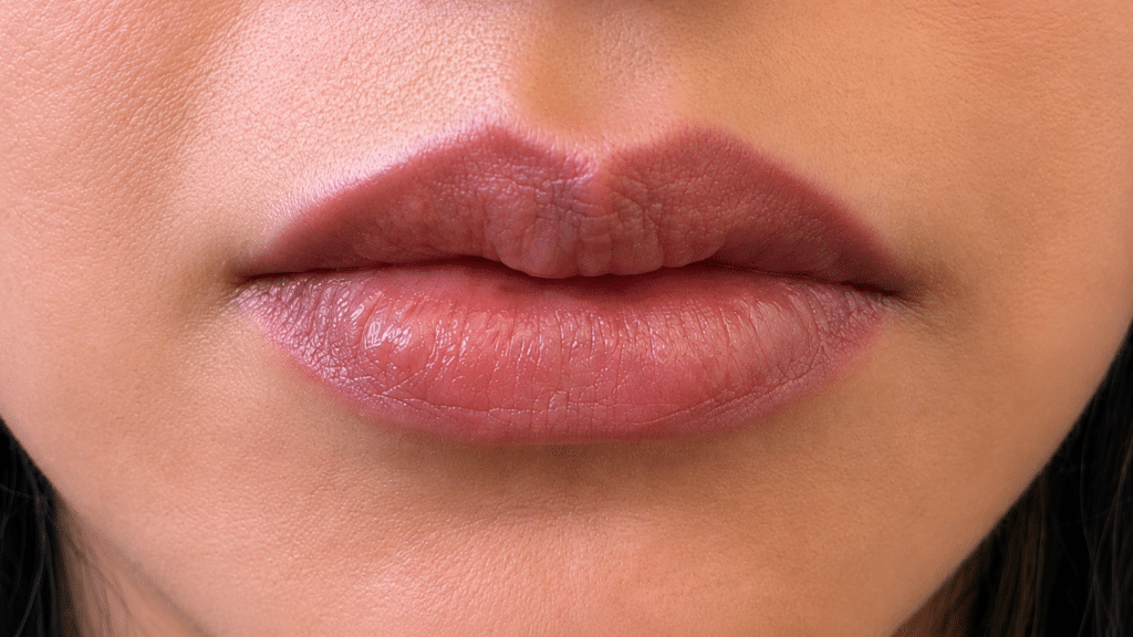 After Image: JUVEDERM VOLBELLA XC – LIP FILLER - front