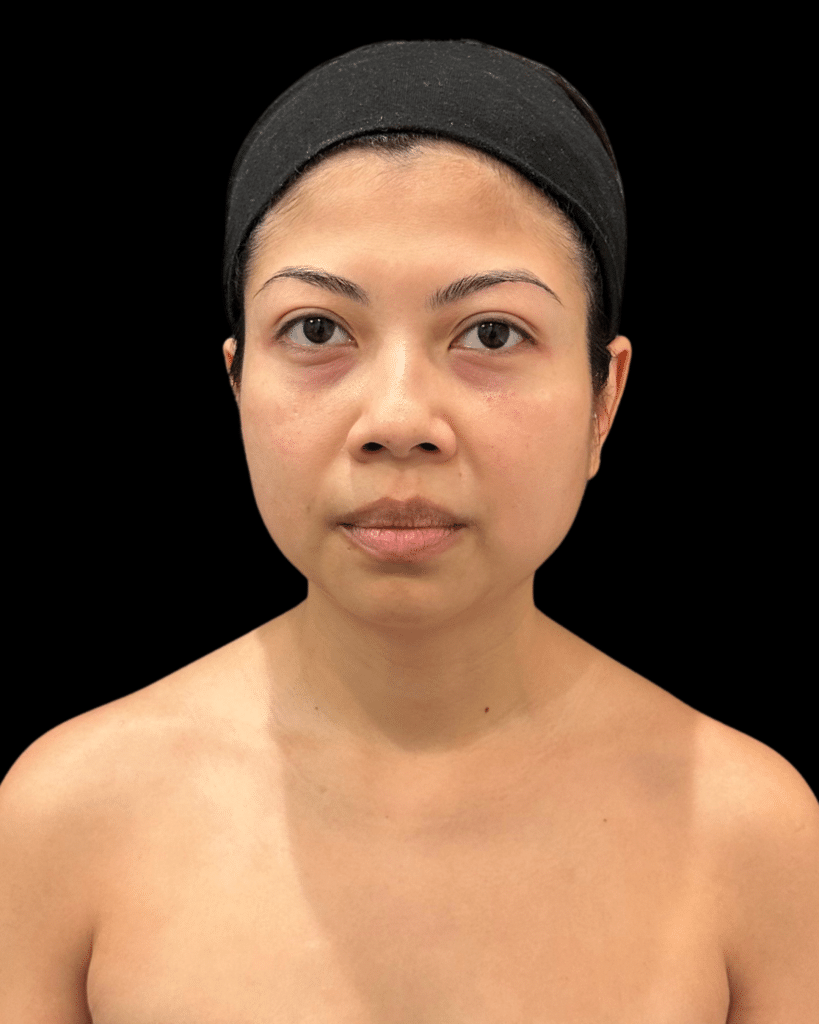 After Image: Ultherapy PRIME® - front