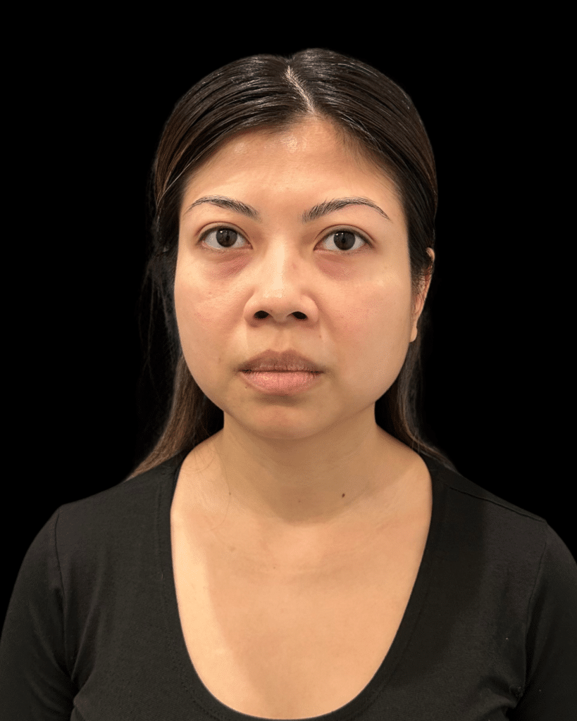 Before Image: Ultherapy PRIME® - front