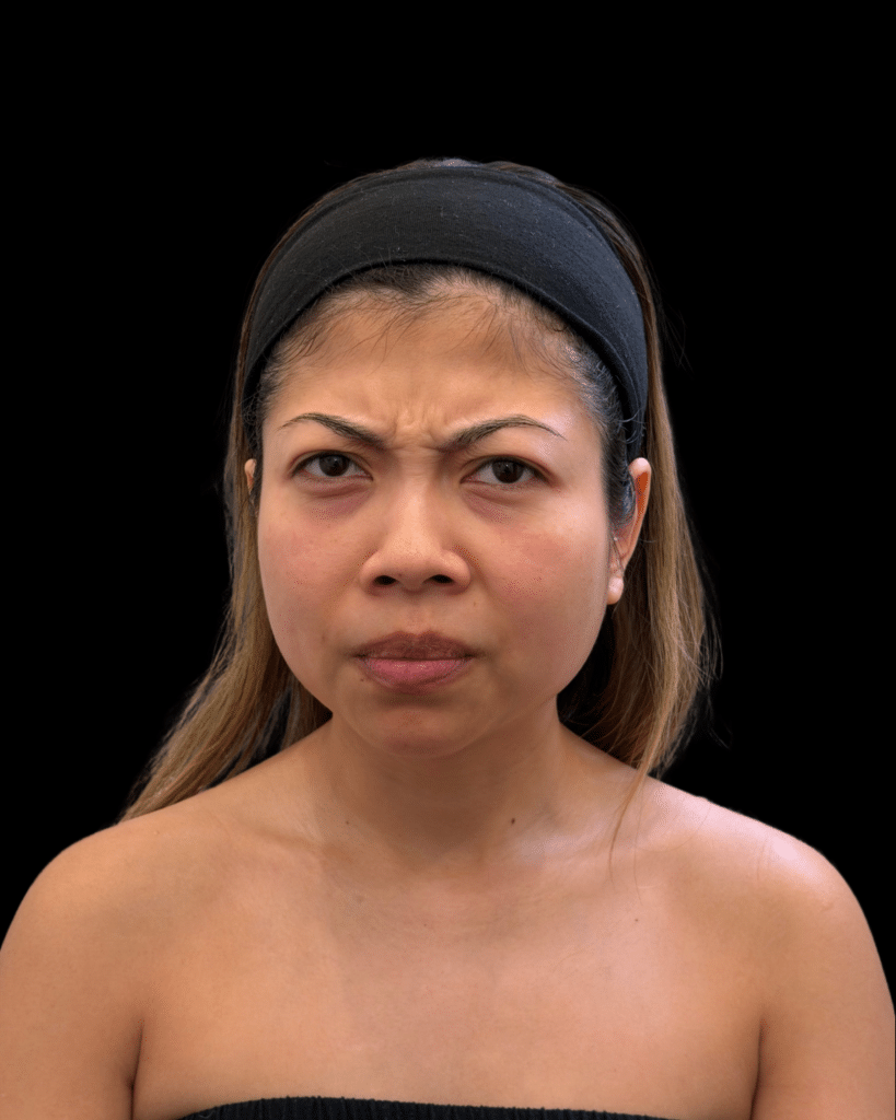 Before Image: BOTOX® - front