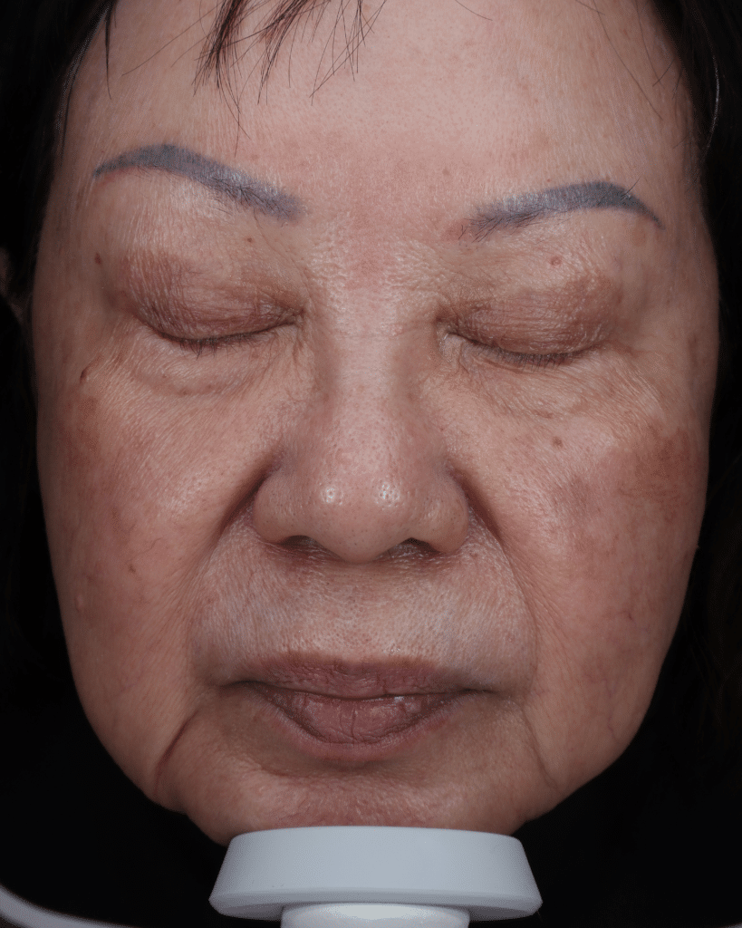 After Image: BBL® HEROic™ + MOXI™ Combination Treatment - front