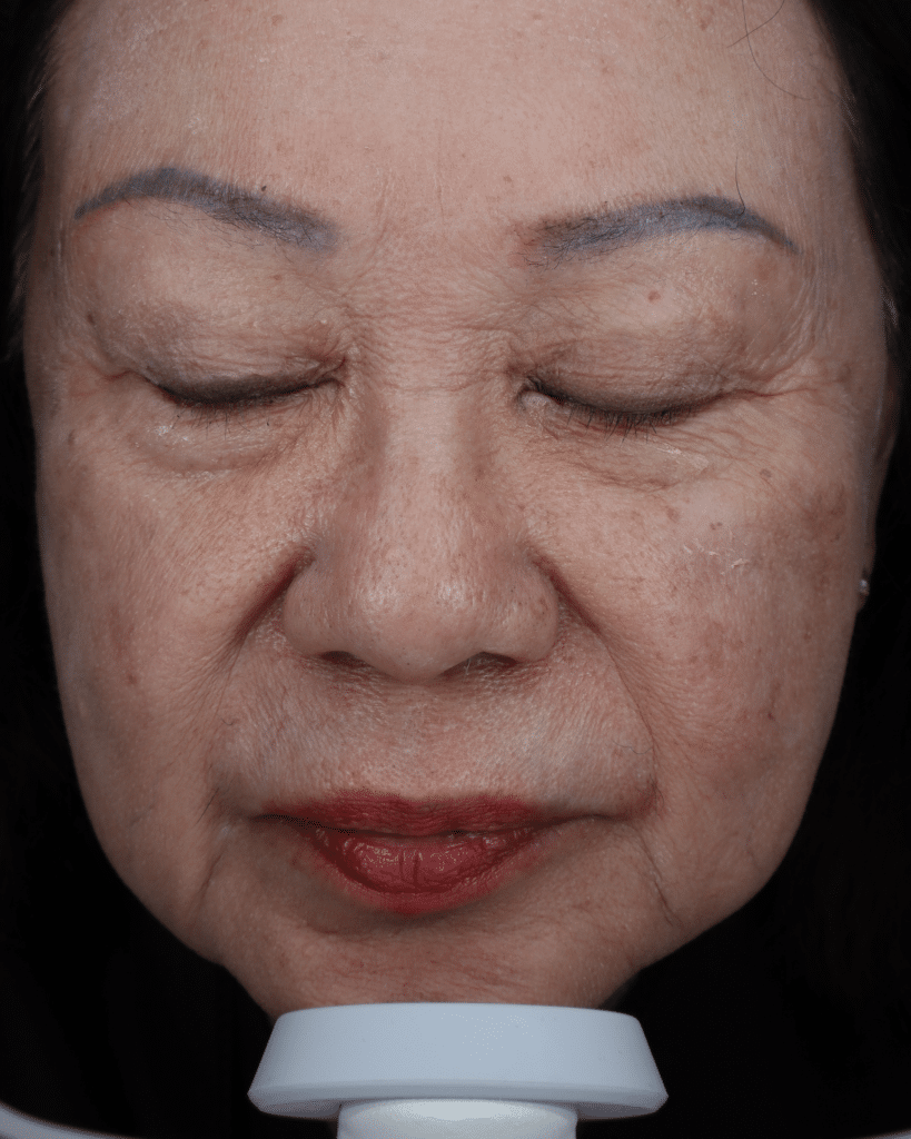 Before Image: BBL® HEROic™ + MOXI™ Combination Treatment - front