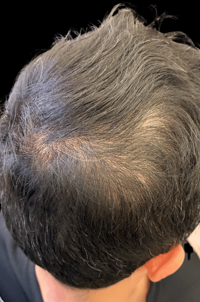 Before Image: PRP Hair Restoration - right-back-oblique